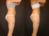 CoolSculpting