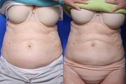 CoolSculpting