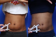 NONCOMPLIANT - CoolSculpting