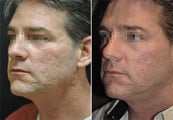 Deep FX for Acne Scarring