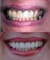 Porcelain crowns