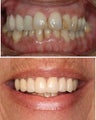 Full porcelain crowns