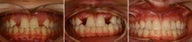 Dental implants before and after
