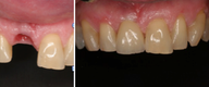 Dental Implant