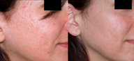 Dermabrasion