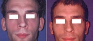 Otoplasty (correction of outstanding ears)