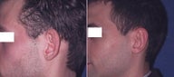 Otoplasty