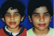 Otoplasty for Protruding Ears
