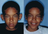 Otoplasty for Protruding Ears