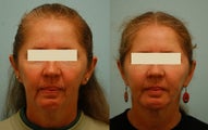 Otoplasty (Cosmetic Ear Pinning)