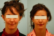 Otoplasty (Cosmetic Ear Pinning)