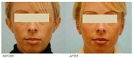 Otoplasty (Cosmetic Ear Pinning)