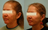 Otoplasty (Cosmetic Ear Pinning)