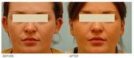 Otoplasty (Cosmetic Ear Pinning)