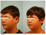 Otoplasty (Cosmetic Ear Pinning)
