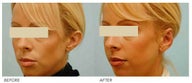 Otoplasty (Cosmetic Ear Pinning)