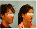 Otoplasty (Cosmetic Ear Pinning)