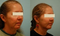 Otoplasty (Cosmetic Ear Pinning)