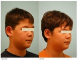 Otoplasty (Cosmetic Ear Pinning)