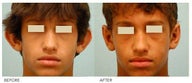 Otoplasty (Cosmetic Ear Pinning)