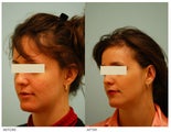 Otoplasty (Cosmetic Ear Pinning)