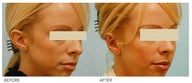 Otoplasty (Cosmetic Ear Pinning)