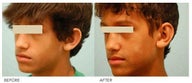 Otoplasty (Cosmetic Ear Pinning)