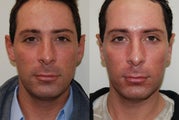 Otoplasty Surgery. 1 week post-op