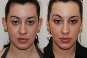 Otoplasty Surgery. 1 month post-op