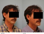 Otoplasty