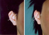 Ear Surgery