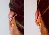 Ear Surgery