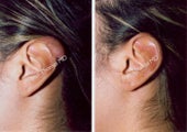 Ear Surgery