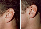 Ear Surgery