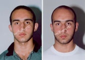 Ear Surgery - Otoplasty