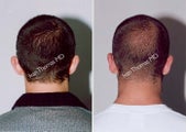 Ear Surgery - Otoplasty