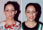 Ear Surgery - Otoplasty