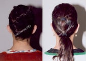 Ear Surgery - Otoplasty