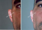 Ear Surgery - Otoplasty