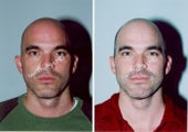 Ear Surgery - Otoplasty