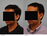 Otoplasty