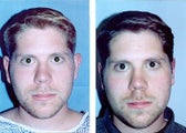 Otoplasty