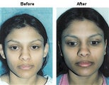 Otoplasty