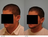 Otoplasty