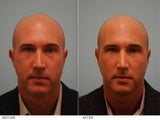 Otoplasty
