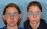 Otoplasty (ear surgery)