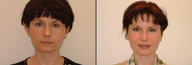 Otoplasty and Rhinoplasty
