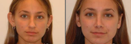 Otoplasty and Rhinoplasty