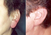 Lobularplasty