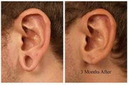 Earlobe Repair